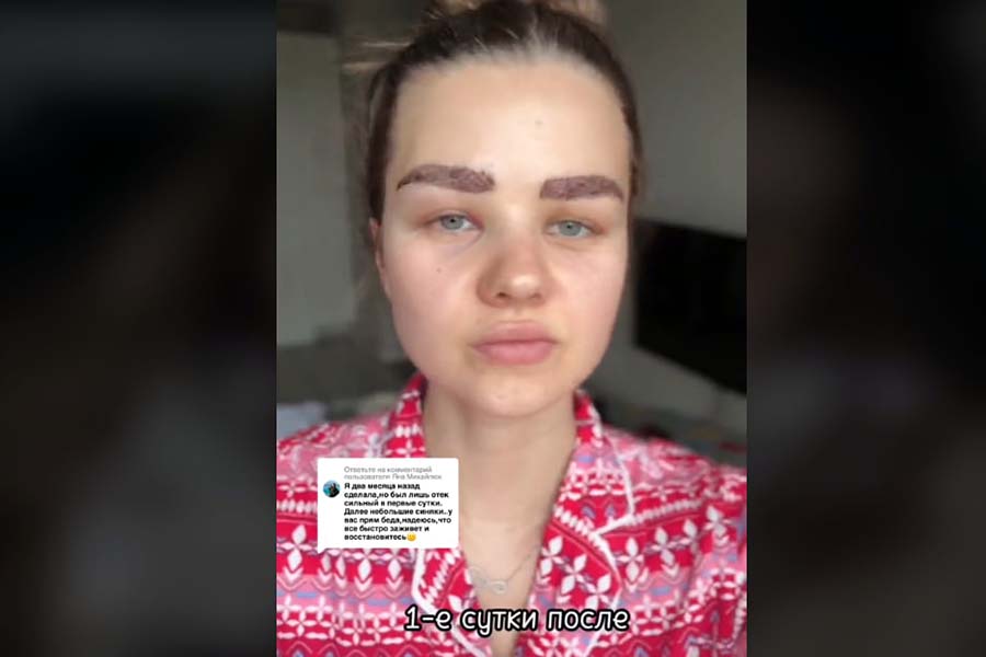 Девушка из Беларуси сделала пересадку бровей — результаты операции выкладывала в TikTok