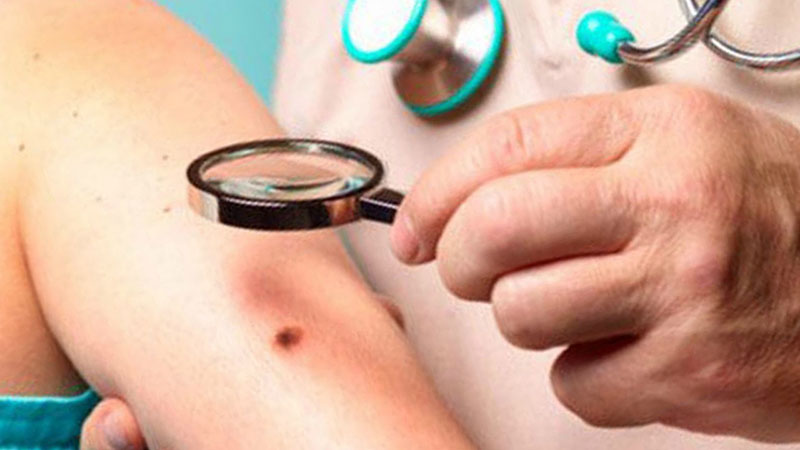 melanoma 1